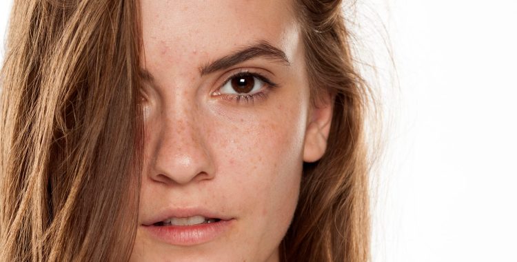 Portrait of young beautiful woman with frackles and problematic skin on white backgeound