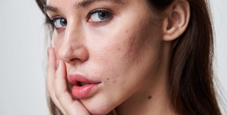 Woman with with post acne spots at her face looking at the camera Close up portrait of beautiful young woman with with post acne spots at her face looking at the camera and keeping mouth slightly open